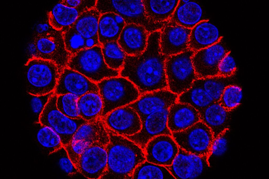 How a Promising Pancreatic Cancer Drug Loses Its Punch