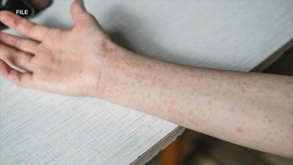 Oxford Area High School closed Friday after confirmed case of measles Oxford Area High School closed Friday after confirmed case of